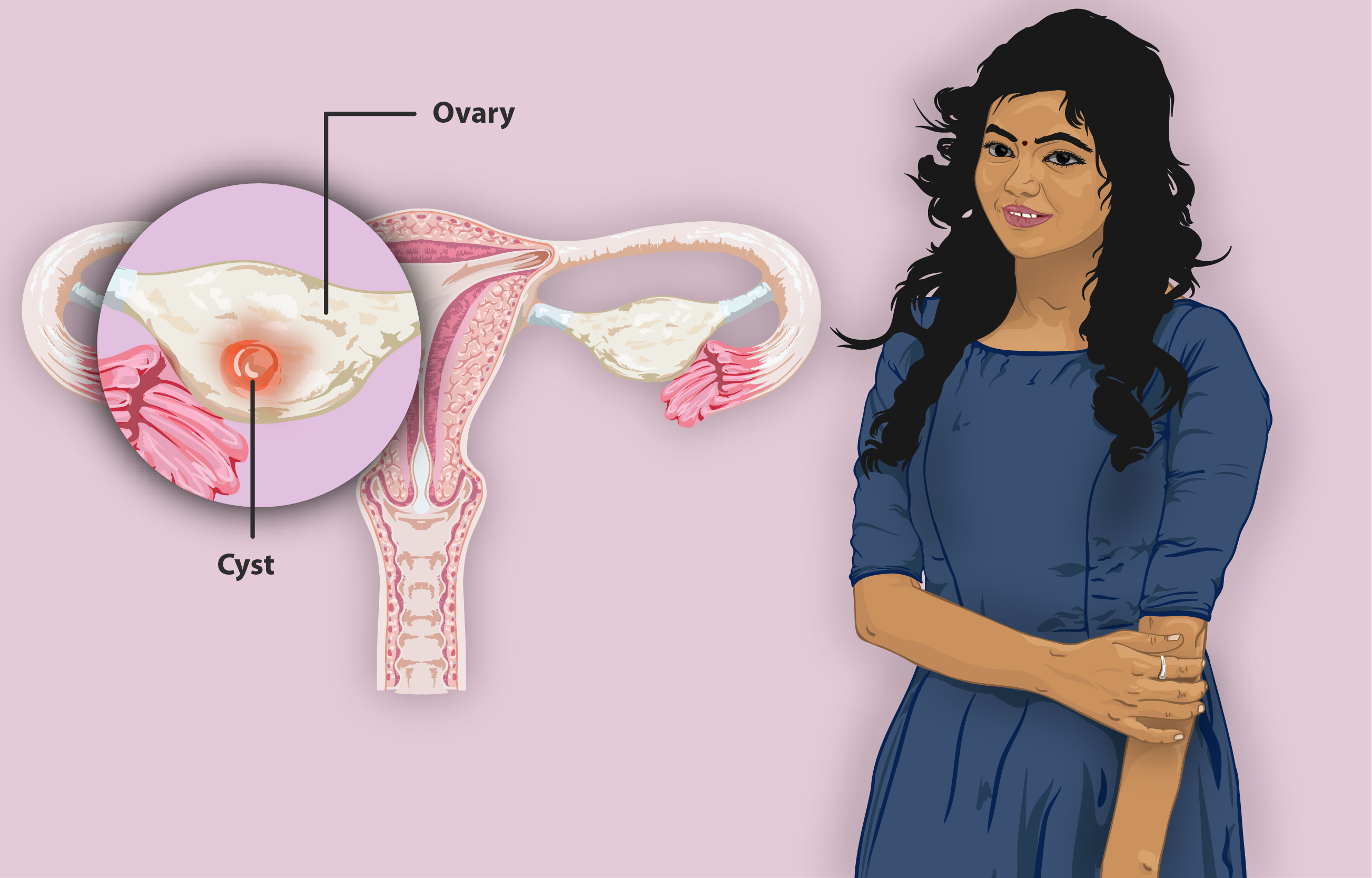 Ovarian Cyst Symptoms Laparoscopycures