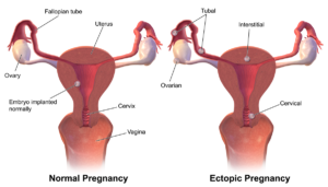 ectopic-pregnancy-symptoms-causes-treatment-in-mumbai