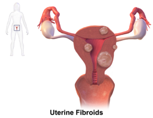 fibroids-treatment