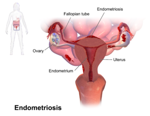 Endometriosis-Treatment- In- Mumbai-India