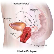uterine-prolapse