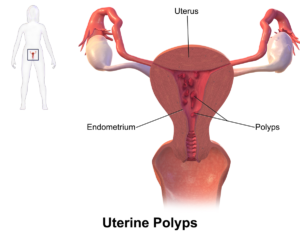 uterine-polyps- treatment